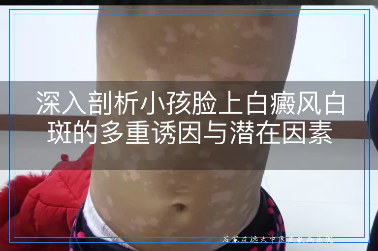 深入剖析小孩脸上白癜风白斑的多重诱因与潜在因素