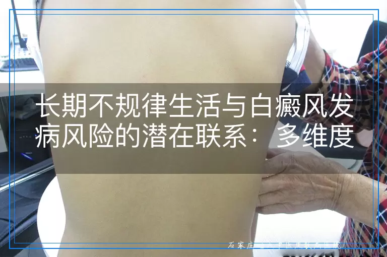 长期不规律生活与白癜风发病风险的潜在联系：多维度探讨