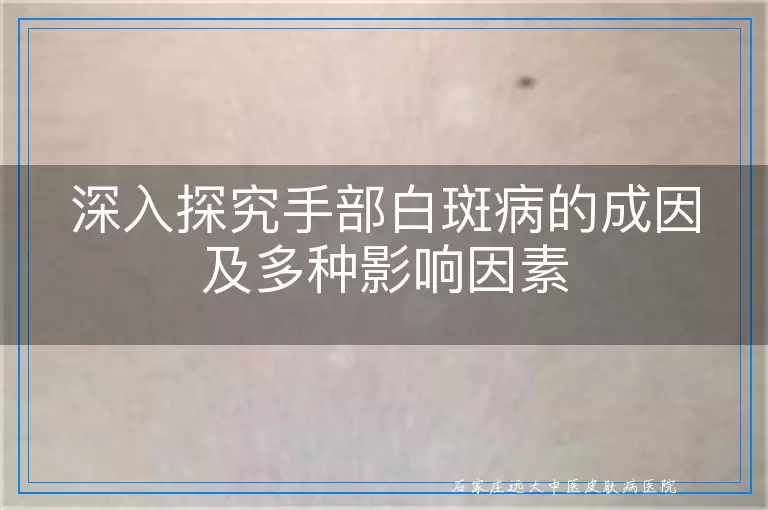 深入探究手部白斑病的成因及多种影响因素