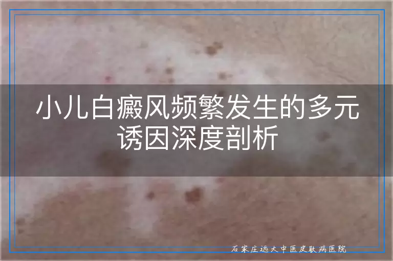 小儿白癜风频繁发生的多元诱因深度剖析