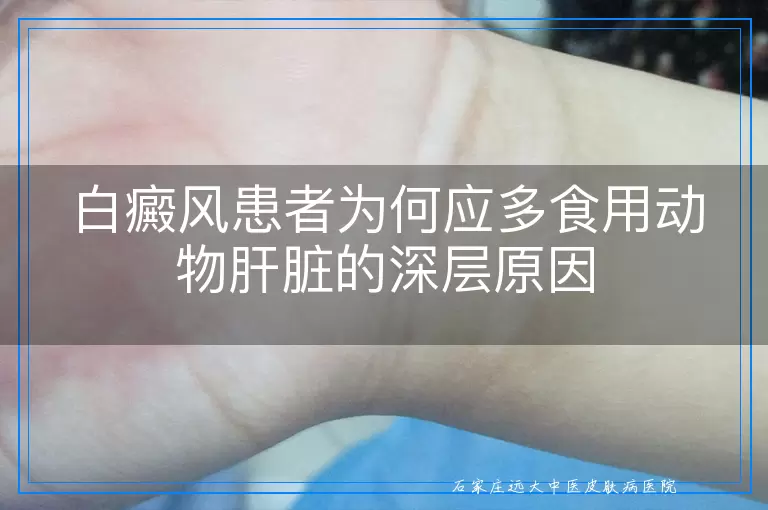 白癜风患者为何应多食用动物肝脏的深层原因