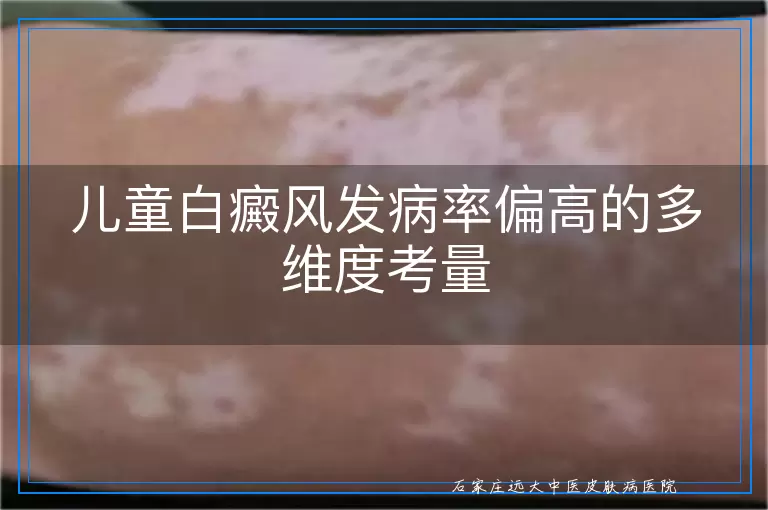 儿童白癜风发病率偏高的多维度考量