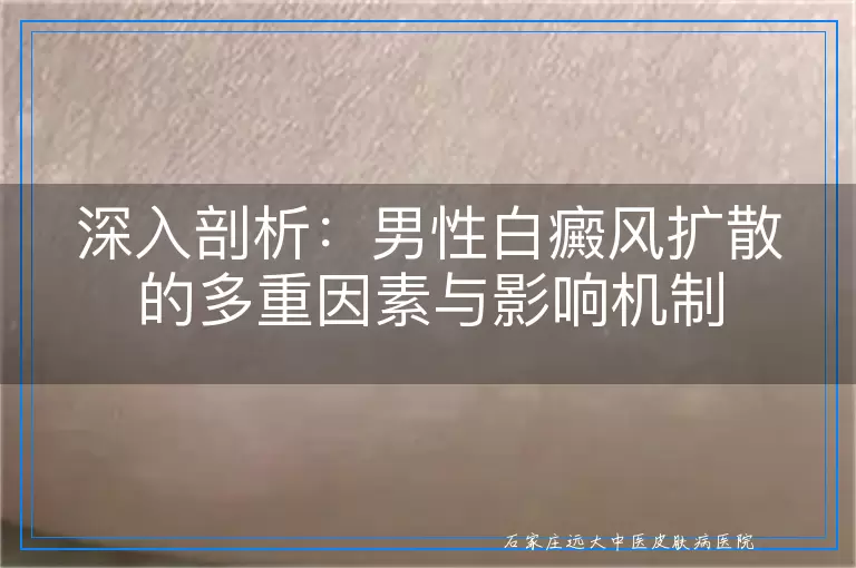 深入剖析：男性白癜风扩散的多重因素与影响机制