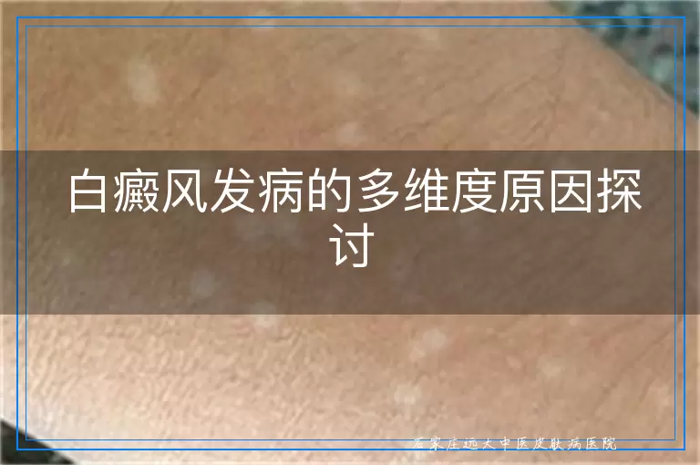 白癜风发病的多维度原因探讨