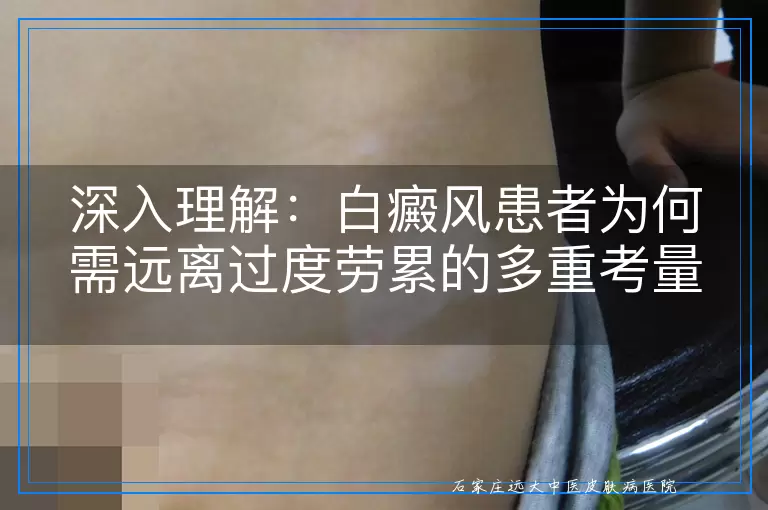 深入理解：白癜风患者为何需远离过度劳累的多重考量