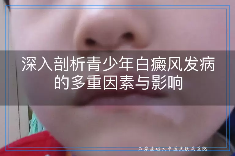 深入剖析青少年白癜风发病的多重因素与影响