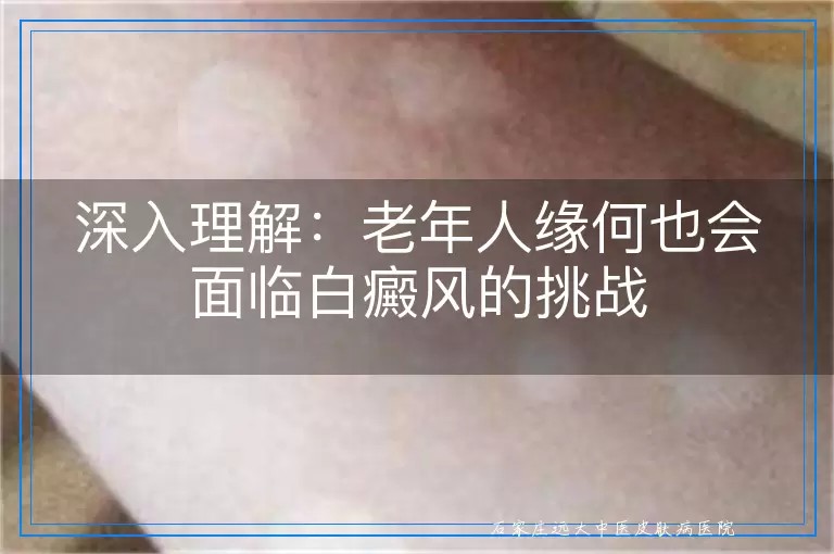 深入理解：老年人缘何也会面临白癜风的挑战