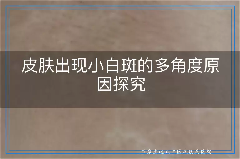 皮肤出现小白斑的多角度原因探究