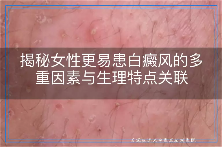 揭秘女性更易患白癜风的多重因素与生理特点关联