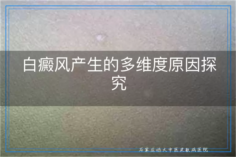 白癜风产生的多维度原因探究