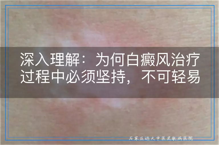 深入理解：为何白癜风治疗过程中必须坚持，不可轻易中断