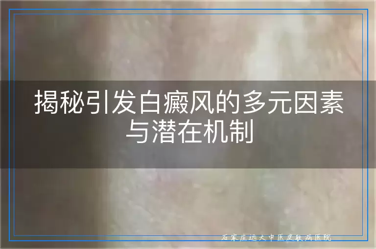 揭秘引发白癜风的多元因素与潜在机制