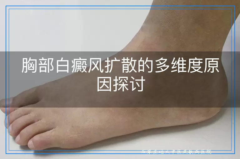 胸部白癜风扩散的多维度原因探讨