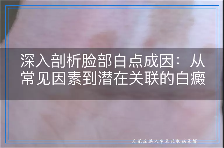 深入剖析脸部白点成因：从常见因素到潜在关联的白癜风风险