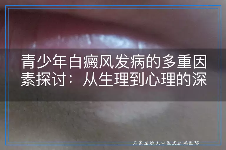 青少年白癜风发病的多重因素探讨：从生理到心理的深度剖析