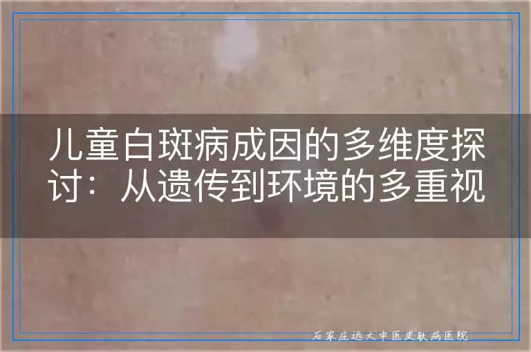 儿童白斑病成因的多维度探讨：从遗传到环境的多重视角