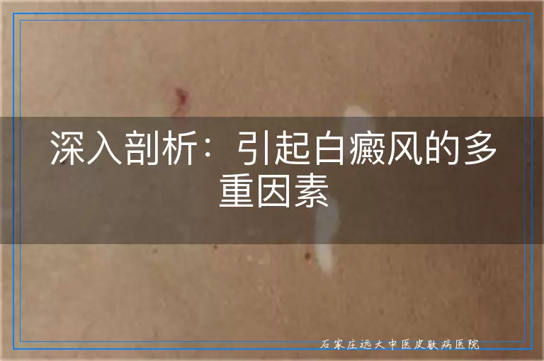 深入剖析：引起白癜风的多重因素