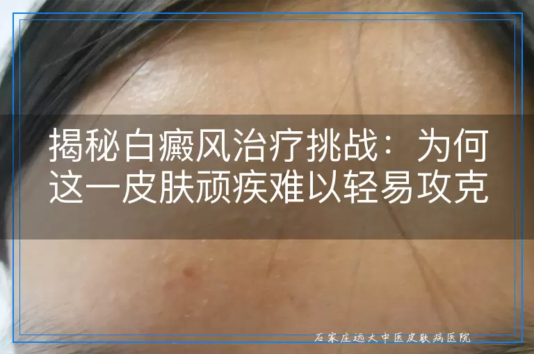 揭秘白癜风治疗挑战：为何这一皮肤顽疾难以轻易攻克