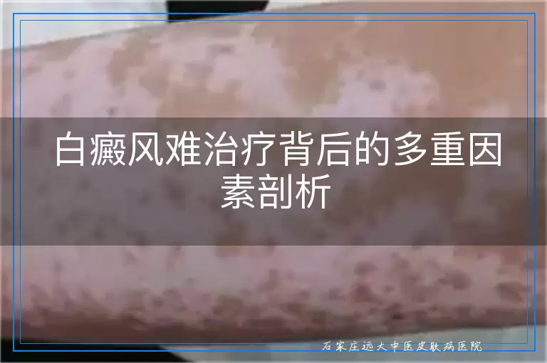 白癜风难治疗背后的多重因素剖析