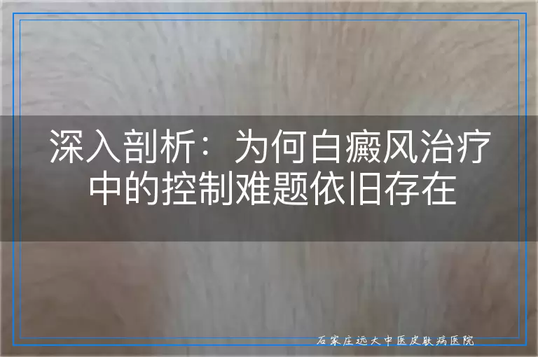 深入剖析：为何白癜风治疗中的控制难题依旧存在