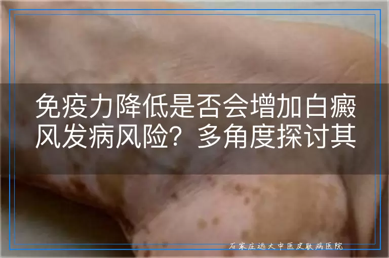 免疫力降低是否会增加白癜风发病风险？多角度探讨其关联性
