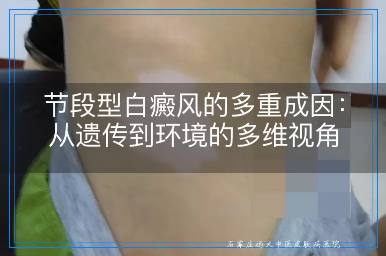 节段型白癜风的多重成因：从遗传到环境的多维视角