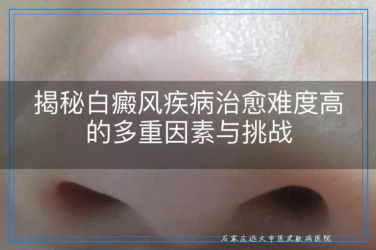 揭秘白癜风疾病治愈难度高的多重因素与挑战