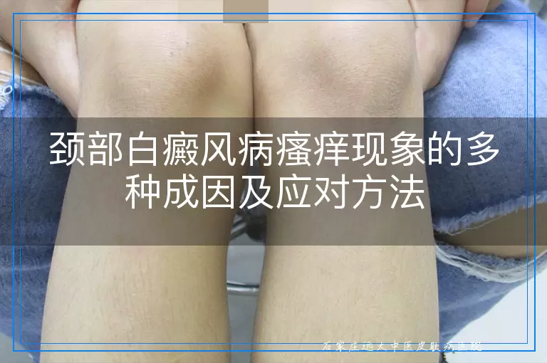 颈部白癜风病瘙痒现象的多种成因及应对方法