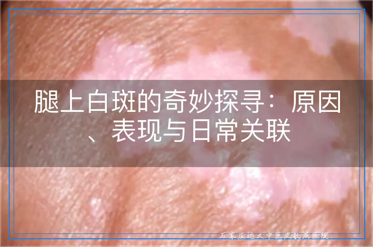 腿上白斑的奇妙探寻：原因、表现与日常关联
