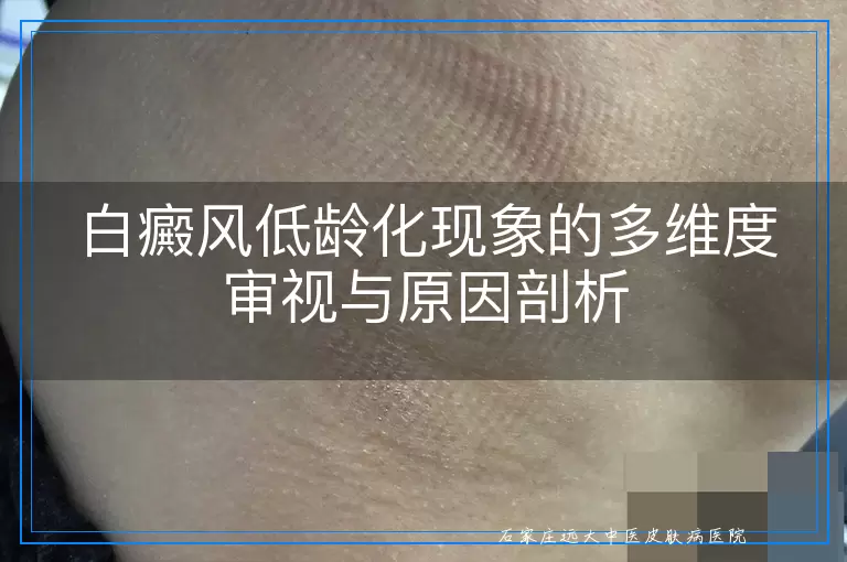 白癜风低龄化现象的多维度审视与原因剖析
