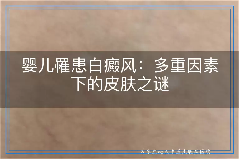 婴儿罹患白癜风：多重因素下的皮肤之谜