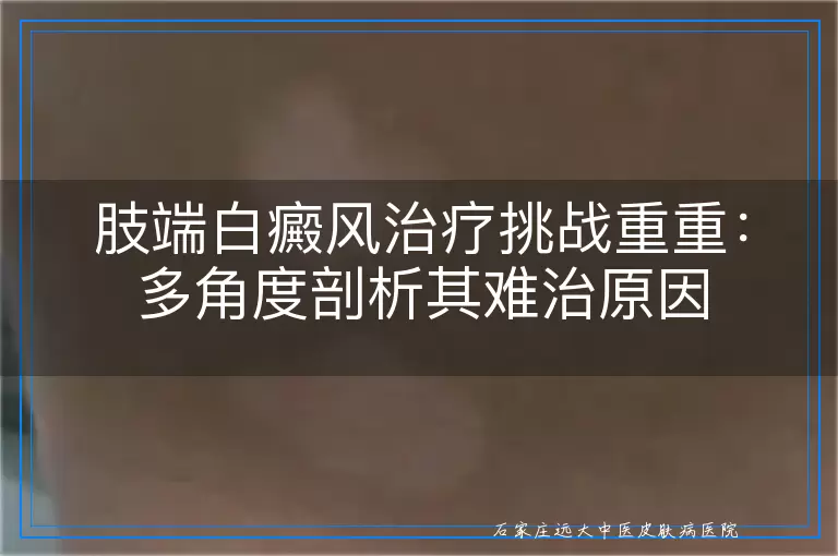 肢端白癜风治疗挑战重重：多角度剖析其难治原因