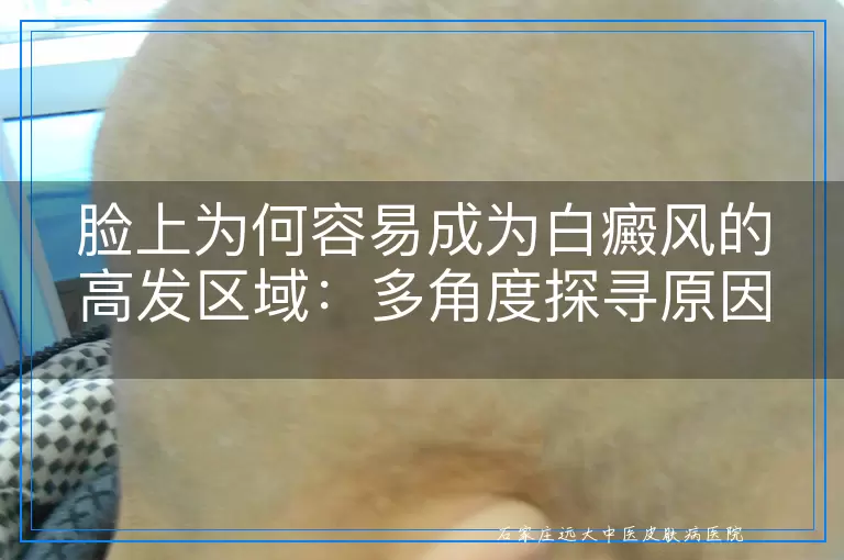 脸上为何容易成为白癜风的高发区域：多角度探寻原因