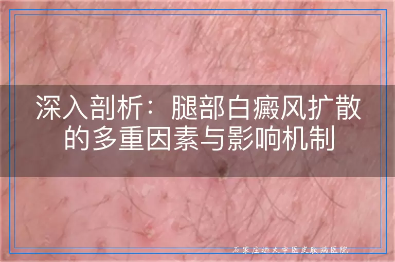 深入剖析：腿部白癜风扩散的多重因素与影响机制