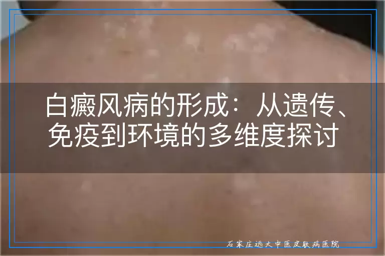白癜风病的形成：从遗传、免疫到环境的多维度探讨