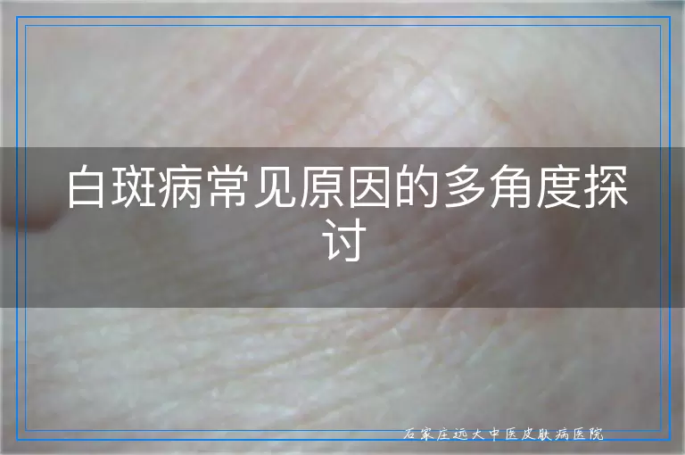 白斑病常见原因的多角度探讨