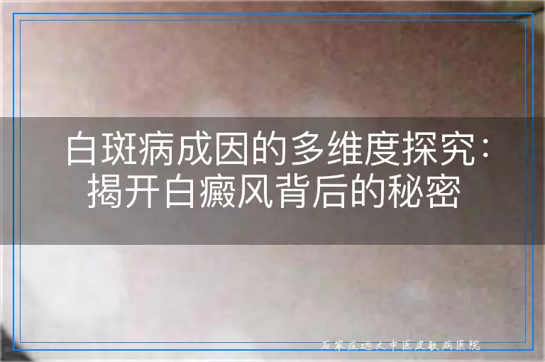 白斑病成因的多维度探究：揭开白癜风背后的秘密
