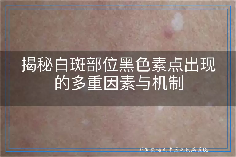 揭秘白斑部位黑色素点出现的多重因素与机制