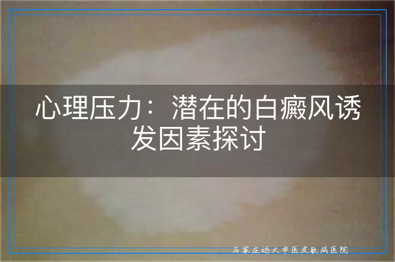 心理压力：潜在的白癜风诱发因素探讨
