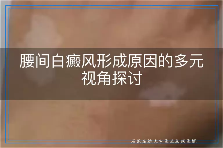 腰间白癜风形成原因的多元视角探讨