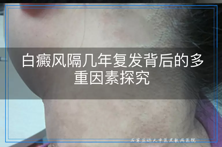 白癜风隔几年复发背后的多重因素探究