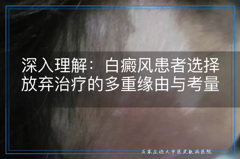 深入理解：白癜风患者选择放弃治疗的多重缘由与考量