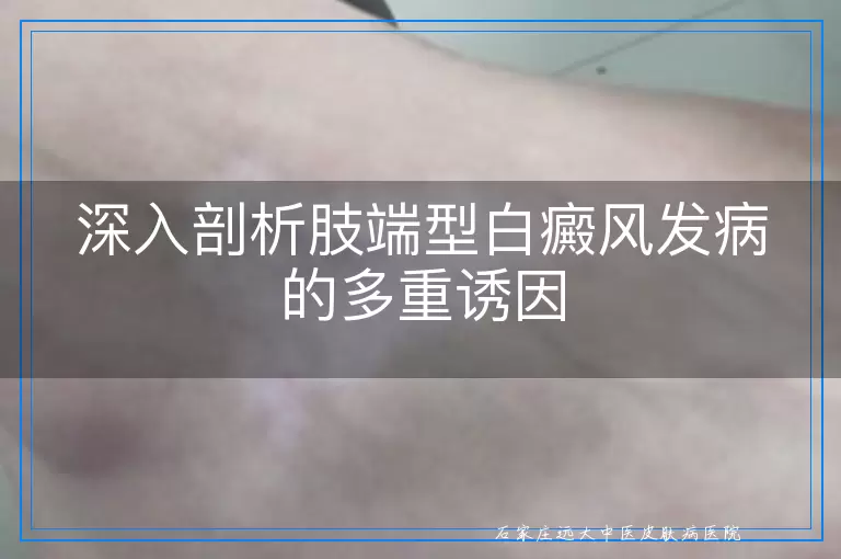 深入剖析肢端型白癜风发病的多重诱因