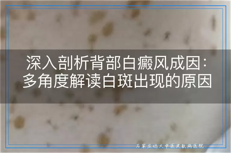 深入剖析背部白癜风成因：多角度解读白斑出现的原因