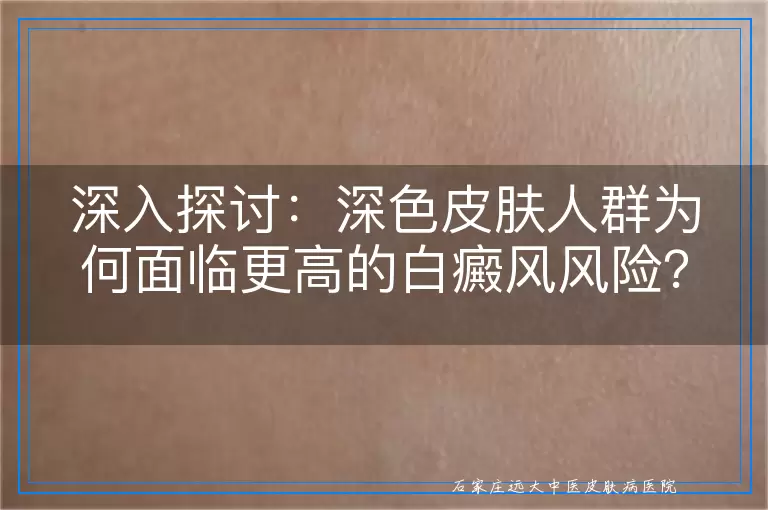 深入探讨：深色皮肤人群为何面临更高的白癜风风险？