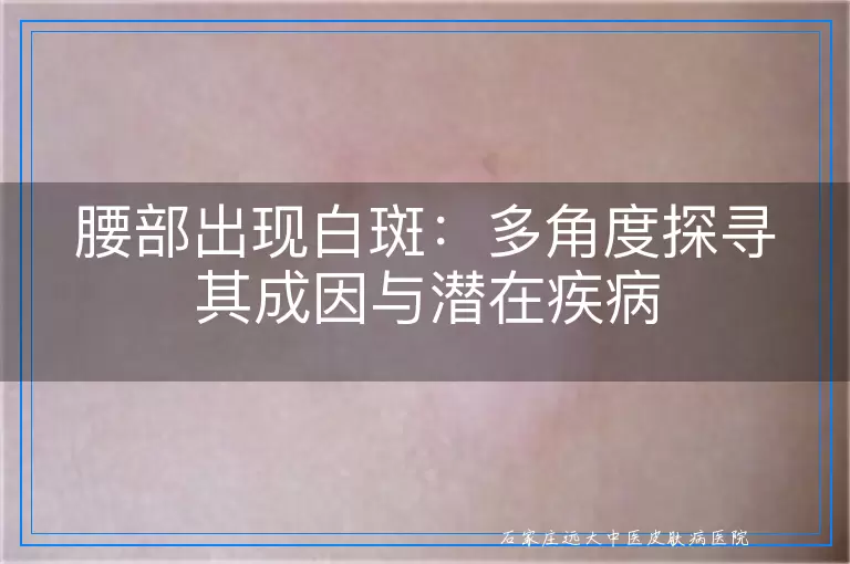 腰部出现白斑：多角度探寻其成因与潜在疾病