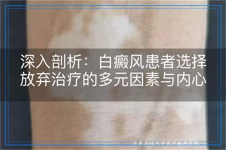 深入剖析：白癜风患者选择放弃治疗的多元因素与内心挣扎