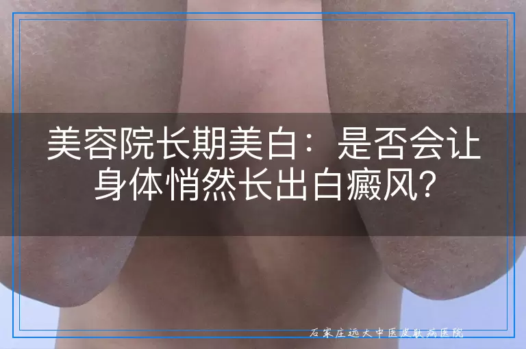 美容院长期美白：是否会让身体悄然长出白癜风？
