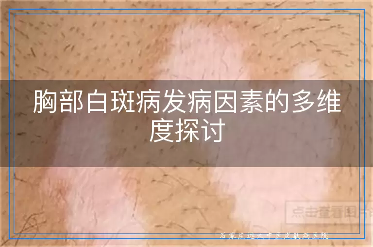 胸部白斑病发病因素的多维度探讨