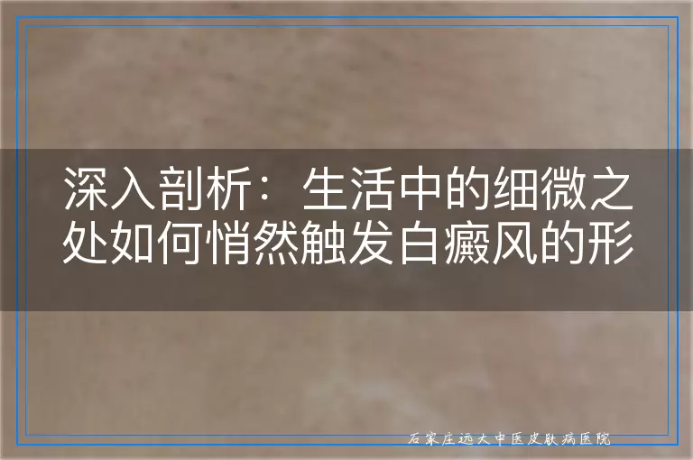 深入剖析：生活中的细微之处如何悄然触发白癜风的形成